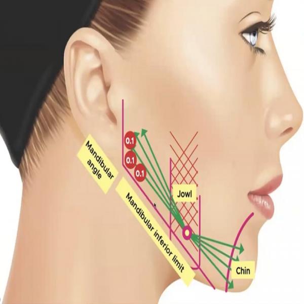 A Safe and Effective Dual Action Treatment for Instant Lifting and Collagen Stimulation with Ellanse