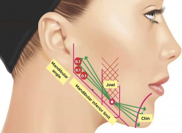 A Safe and Effective Dual Action Treatment for Instant Lifting and Collagen Stimulation with Ellanse